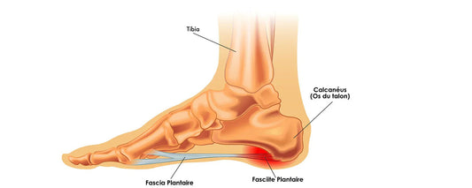 Fasciite plantaire : comprendre la douleur au talon - Runlys